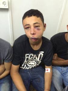 Tarek Abu Khdeir luego de ser torturado por la policía israelí.